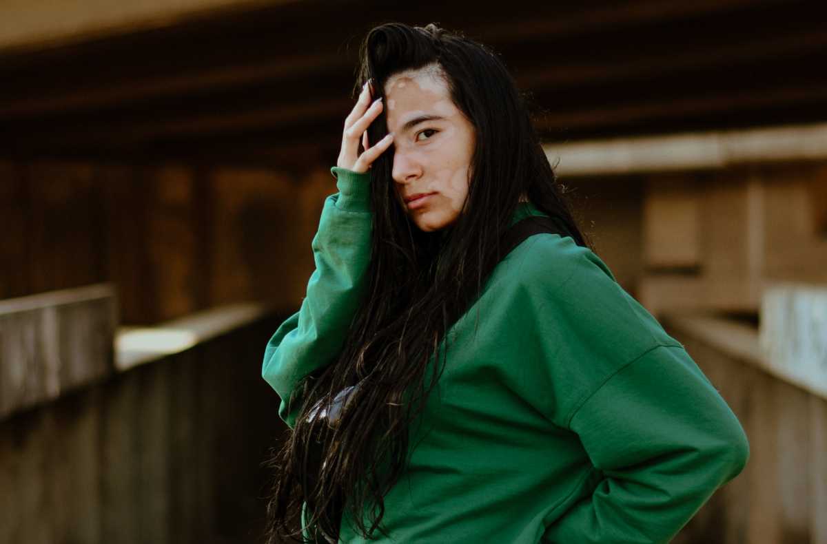 woman with vitiligo